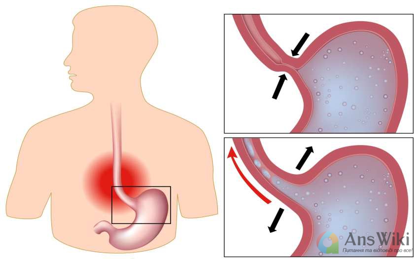 Що таке шлунково-стравохідний рефлюкс?